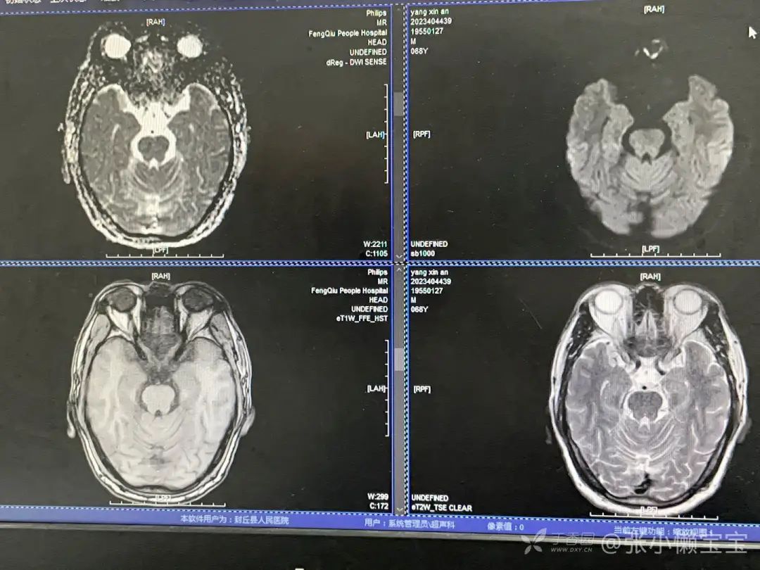 头颅 MRI 示双侧对称性病变，这些病都要想到！-医博网