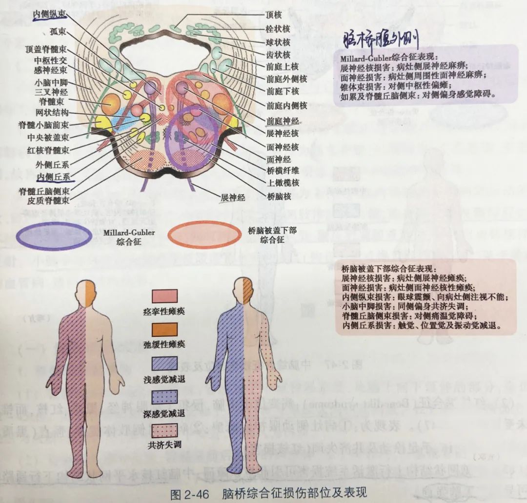 脑干内 vs 脑干外病变，临床如何鉴别？-医博网