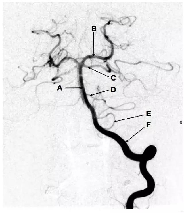 脑血管造影 DSA 不会看？教你 3 步轻松搞定！-医博网
