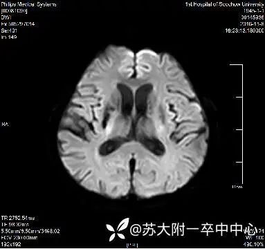 下肢进行性无力，应该如何诊断？-医博网