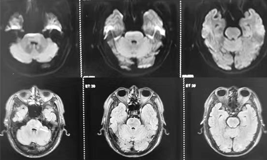 眩晕伴走路不稳，头核磁发现典型影像…-医博网